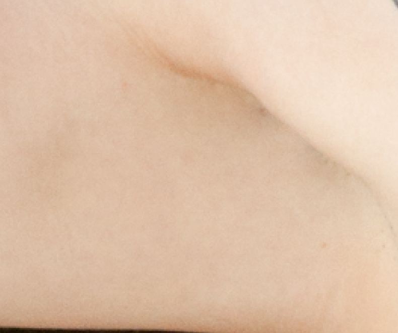 Patched Armpit